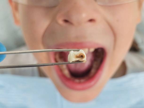 Best Emergency Wisdom Teeth Removal in Vienna, GA